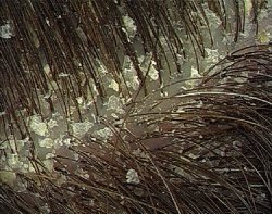 как избавиться от перхоти