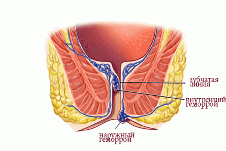 наружный и внутренний геморрой