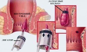 лигирование геморроя латексными кольцами