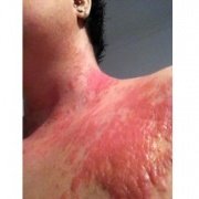 аллергия на солнце фото