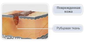 следы от ветрянки на коже