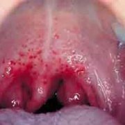 Скарлатина, фото языка и горла
