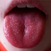 Скарлатина, малиновый язык