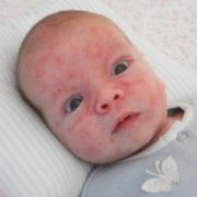 проявление диатеза у детей