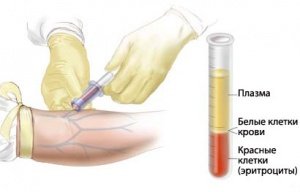 тесты на ртуть при аутизме