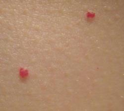 красные точки на лице