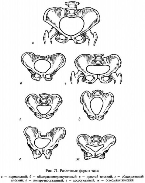 виды таза