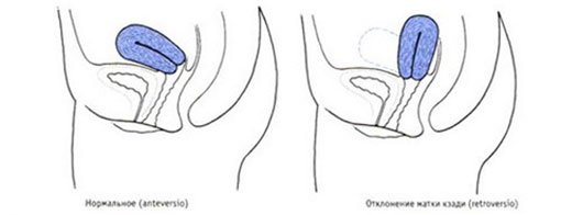 виды загиба матки