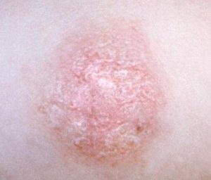 цветной лишай