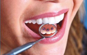 лингвальные брекеты