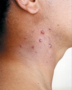 вросшие волоски 2