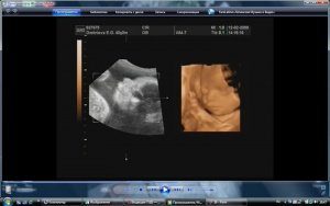 икота у плода