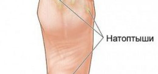 натоптыши