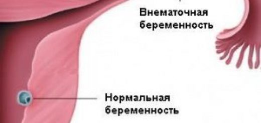 внематочная беременность