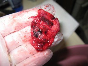 симптомы выкидыша