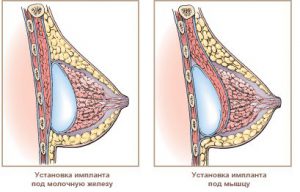 импланты