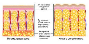 целлюлит