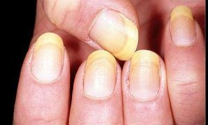 грибок ногтей