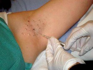 лечение потливости