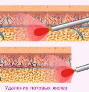 гипергидроз