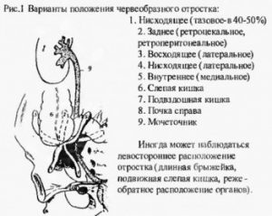 расположение аппендикса