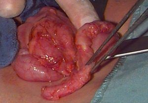 Хронический аппендицит. Кисты червеобразного отростка