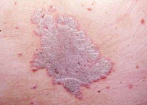 бляшковидный псориаз