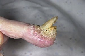 псориаз ногтей