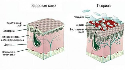 Новые методы лечения псориаза в году