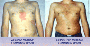 ПУВА-терапия