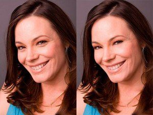 избавление от мешков под глазами современными методами