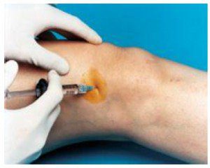 гиалуроновая кислота в медицине