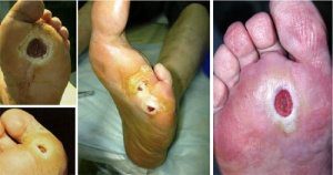 диабетическая стопа