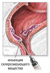склеротерапия