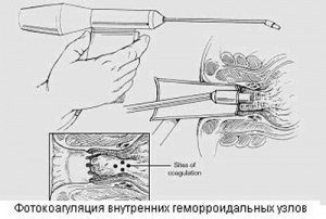 инфракрасная фотокоагуляция