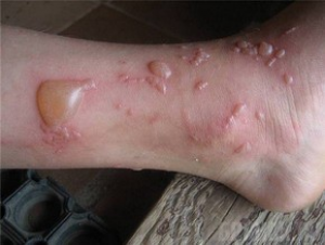 солнечная аллергия