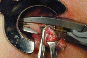 хирургическое лечение геморроя