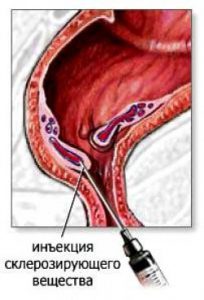 склеротерапия при геморрое