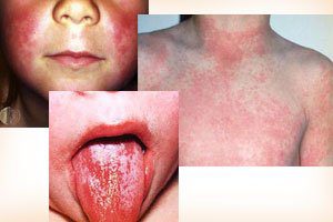 скарлатина у детей