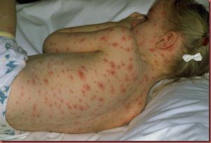 Ветрянка, фото у детей