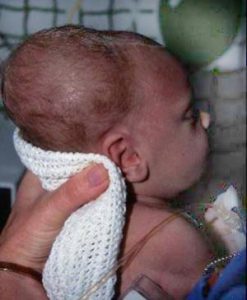 родовая опухоль