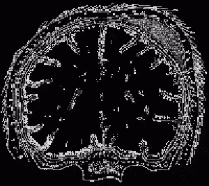 родовые травмы