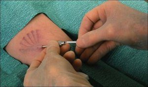 подкожные импланты Норплант