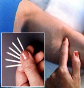 имплантационная контрацепция