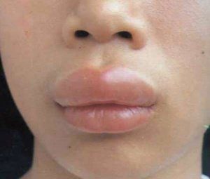 аллергия на косметику на губах