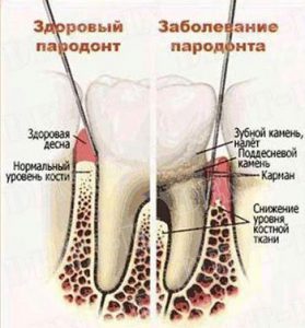 парадонтоз