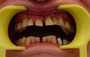 лечение пародонтоза