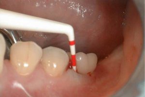 способы лечения парадонтоза