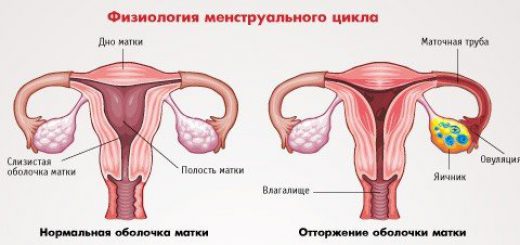 боли при месячных