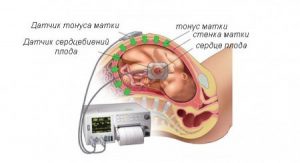 диагностика при гипертонусе
